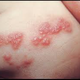 Illustration for article titled obat herpes manjur